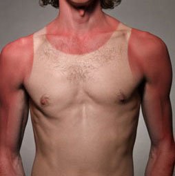 scottatura solare