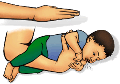 soffocamento neonato